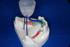 金属床義歯の作り方