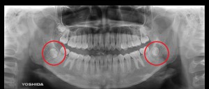 親知らずの歯胚抜歯