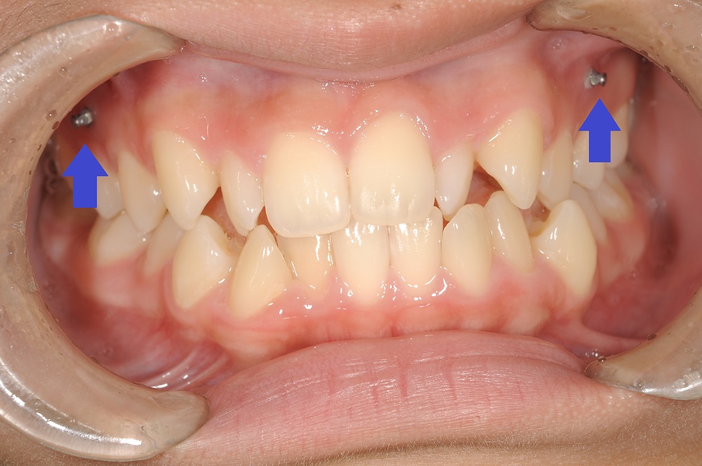 （治療例）歯列矯正治療の前処置について「アンカースクリュー」