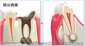 根管治療