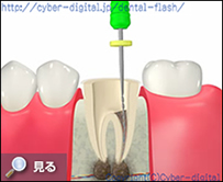 根管治療　ファイル