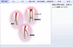 複雑な歯の内部