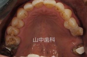 痛くない入れ歯によるかみ合わせ治療 (1)