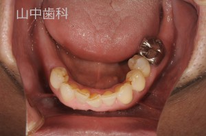 痛くない入れ歯によるかみ合わせ治療 (2)
