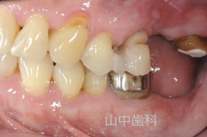 痛くない入れ歯によるかみ合わせ治療 (3)