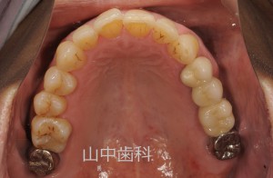 痛くない入れ歯によるかみ合わせ治療 (7)