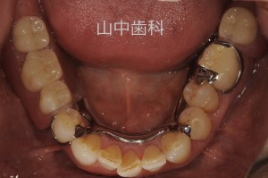 痛くない入れ歯によるかみ合わせ治療 (8)