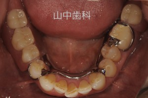 痛くない入れ歯によるかみ合わせ治療 (8)