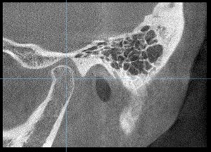 顎関節のCT