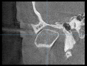 顎関節のCT