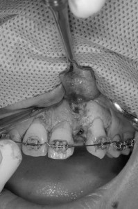 前歯のインプラント１