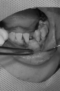 前歯のインプラント治療１０