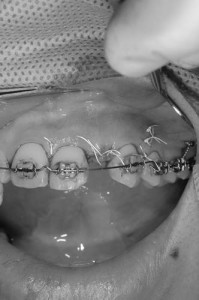 前歯のインプラント３