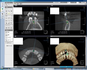 インプラント治療６