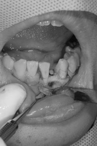 前歯のインプラント治療８