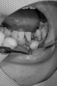 前歯のインプラント治療９