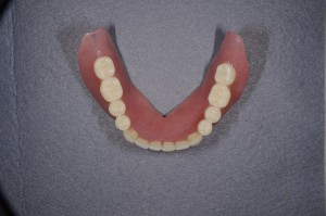ダイナミック印象による義歯 (4)