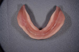 ダイナミック印象による義歯 (6)