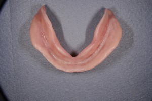 ダイナミック印象による義歯 (7)