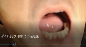 ダイナミック印象による義歯（開口）