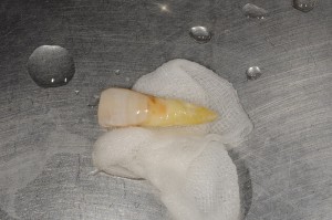 歯牙脱臼３
