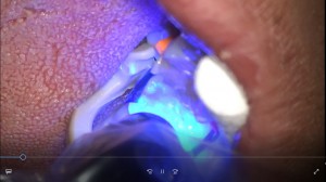 マイクロスコープによる歯科治療