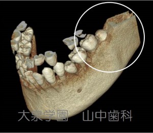 親知らずのCT画像