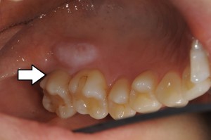 歯科ブログ 問い合わせの多い治療 親知らずの手前の虫歯