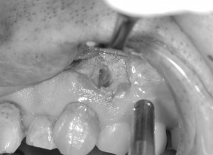 歯の内部に空いた穴の修復