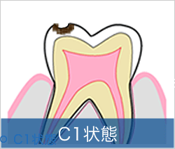 C1状態