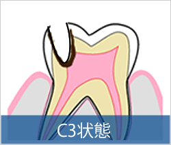 C3状態