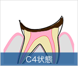 C4状態