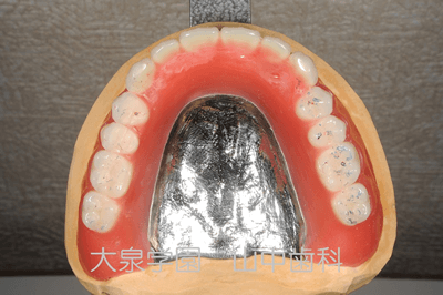 金属床フレームと人工歯排列の試適