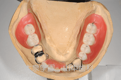 金属床フレームと人工歯排列の試適