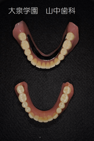 上：完成義歯/下：旧義歯