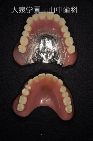 上：完成義歯/下：旧義歯