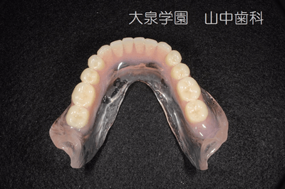 精密入れ歯治療例 症例 フレンジテクニック オルタードキャスト法