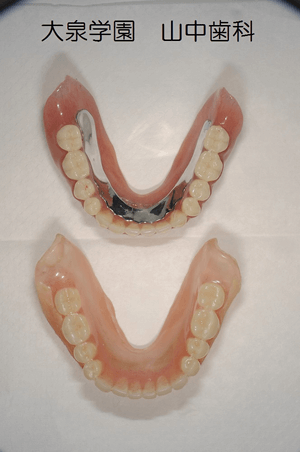 上：最終精密義歯・下：治療用義歯