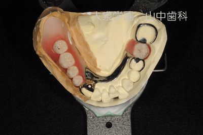 人工歯排列