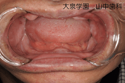 初診時口腔内
