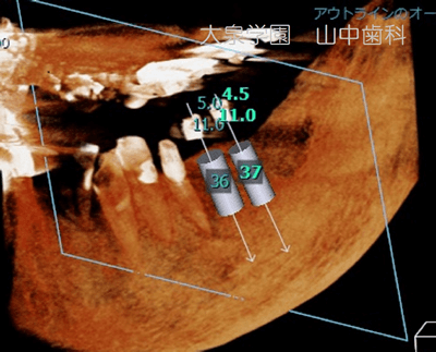 CT画像上でのインプラントシミュレーション