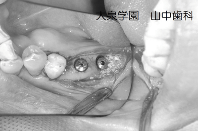 骨欠損部位に人工骨を填入