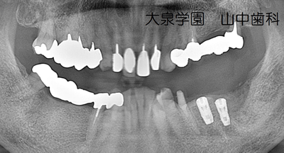 数ヶ月の治癒期間中