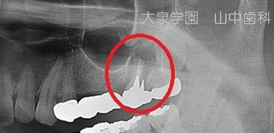 サイナスリフトと呼ばれる治療法