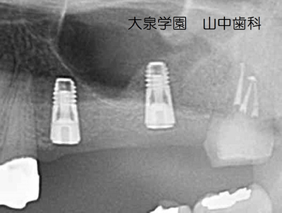 術後のCT撮影像