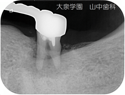 歯槽骨の吸収を伴う保存困難な歯