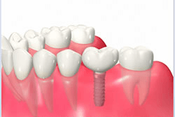 インプラント治療