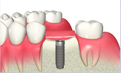 インプラント体の埋入