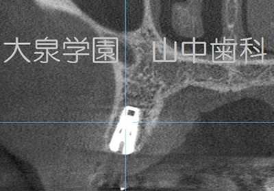 歯科用CT