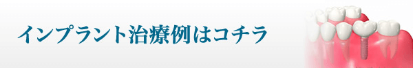 インプラント治療例はコチラ